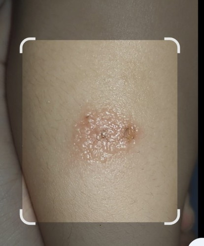 Insect bite