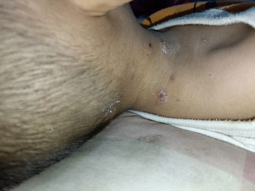 Gatal-gatal seperti korengan