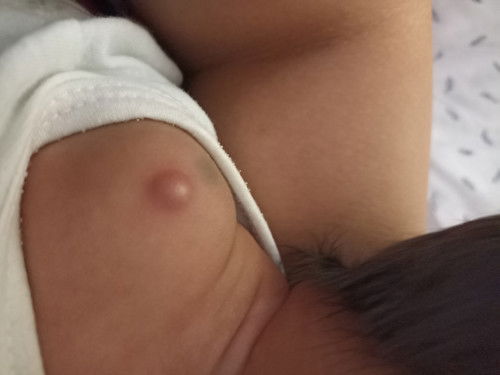 bukol sa braso ng baby