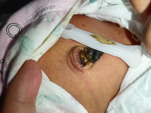 NATANGGAL NA PUSOD NI BABY KASO BASA PA MGA MII ANO GAGAWIN SOBRANG NAG WOWORRY NKO.