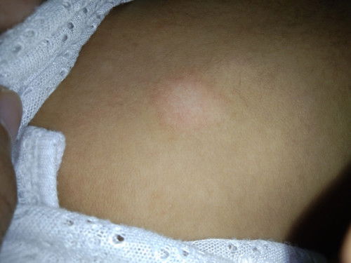 Ano kaya to mga mommy nasa likod kase nang 4months baby ko eh