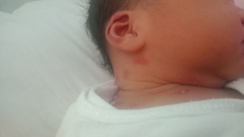 Rashes Ng baby