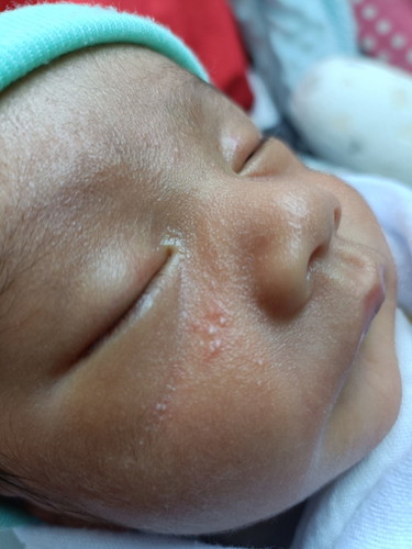 ลูก10กว่าวันมีผดผื่นและตุ่มใสบนใบหน้าแบบนี้ทำไงดีคะ