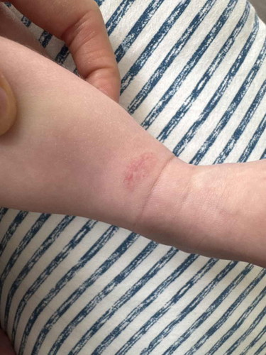 Rashes that wont fade for almost 3 weeks