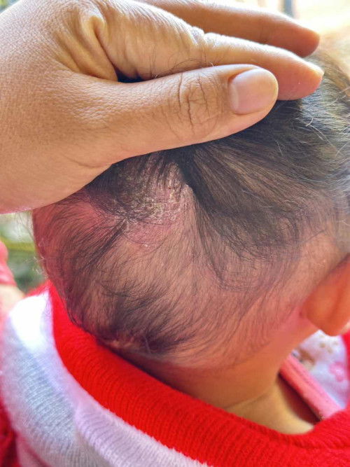 น้องเป็นผื่นที่หัวแบบนี้ ทำไงหายคะ