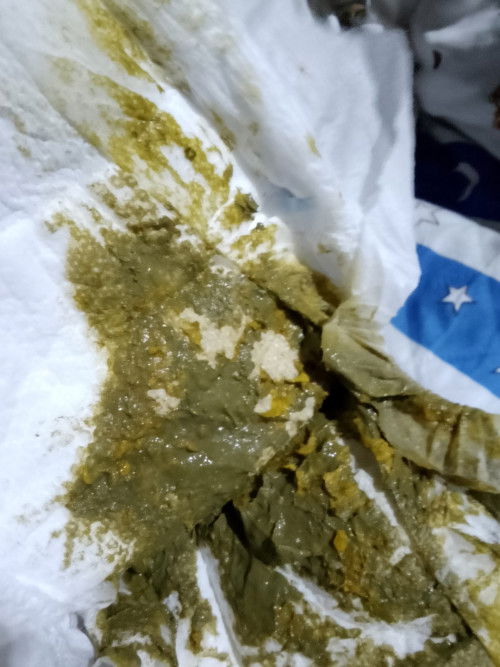 Normal ba for 2months going 3 ang mag poop ng basa tas kulay greeen?