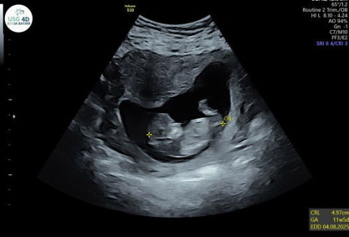 Kalo di bidan 13week kalo usg dokter 12week