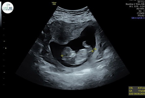 Kalo di bidan 13week kalo usg dokter 12week