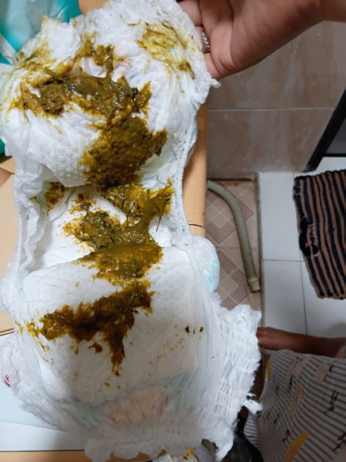 Anak mpasi alergi susu sapi,minum susu bmt php pup hijau