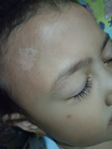 Kulit anak