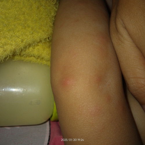 Penyakit kulit pada anak