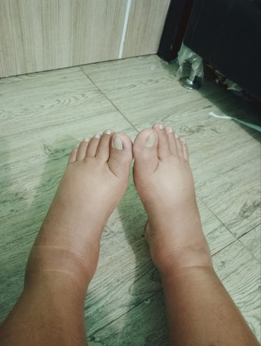 บวมมาก รบกวนช่วยแนะนำหน่อยค่ะ