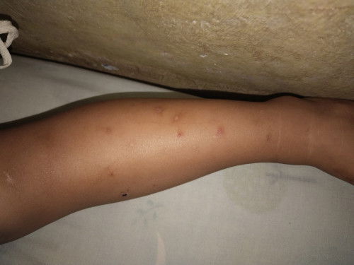 Cara ngilangin bekas Bopeng Luka / Gigitan nyamuk