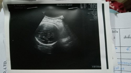 ขอสอบถามคะแม่ๆ37สัปดาห์ตรวจเจอน้ำในโพรงสมองลูกน้องมีโอกาสหายเองไหมค่ะหลังคลอดแม่กังวลมากคะ😭🙏