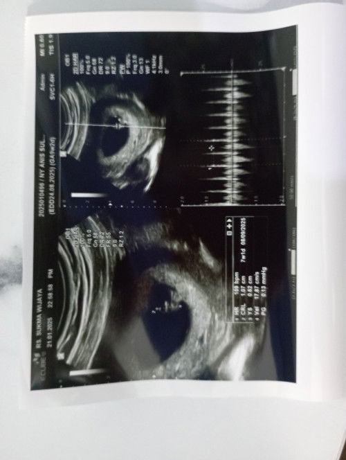 Usia kehamilan berbeda antara di bidan dan dokter