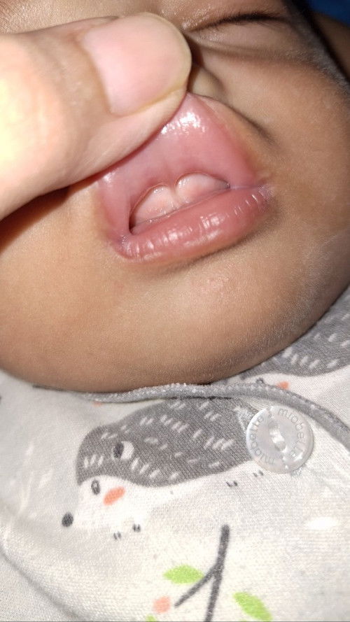 Apakah ini Lip tie atau bukan?