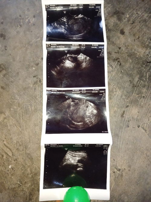 Hamil 6 minggu blm kelihatan kantong janin