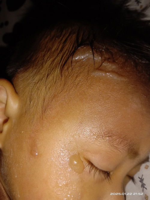 salep yg bisa menyembuhkan luka bakar/melepuh