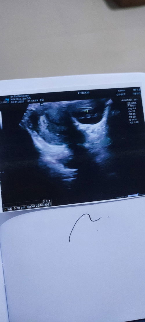 4W5D hasil USG kantong dan Janin sudah kelihatan tapi Janin PEYANG🥺