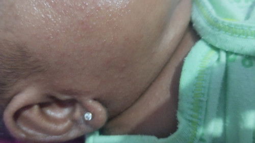 Obat bruntusan yang bagus