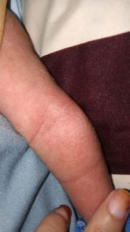 Bruntusan pada newborn