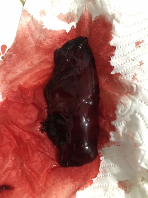 หัวใจเด็กหยุดเต้น (แท้ง)