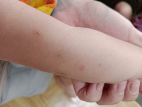 Red rash na parang kagat
