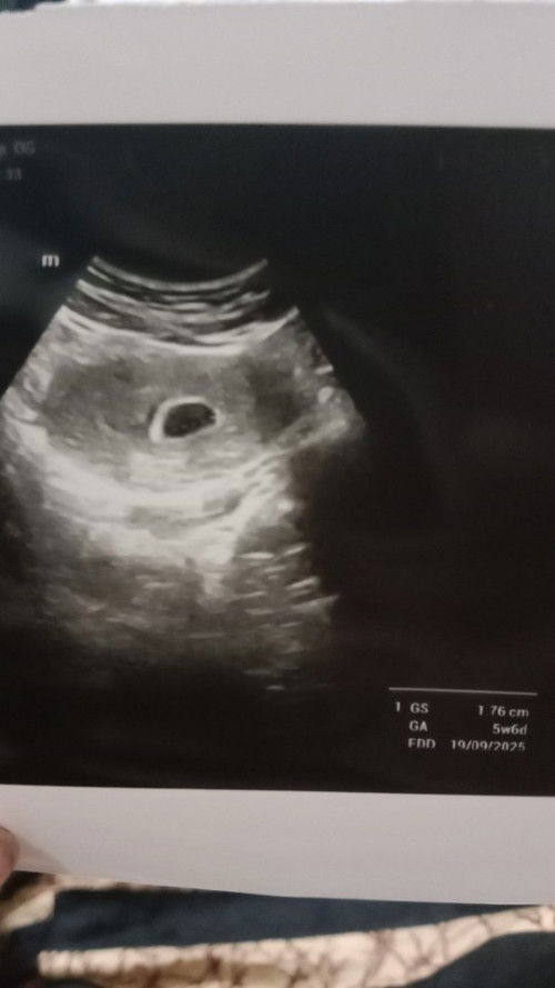 Hpht 7w tapi belum terlihat janin
