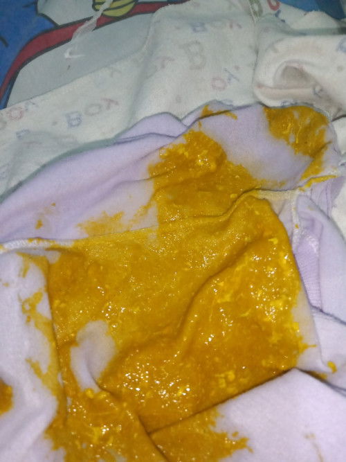 Bab bayi setelah MPASI seperti yg di gambar,, sebelumnya sempet diare apakah babnya normal