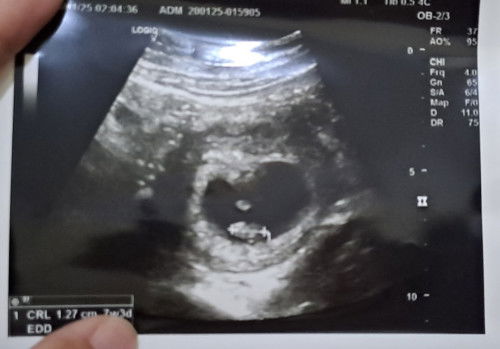 Kantong kehamilan besar