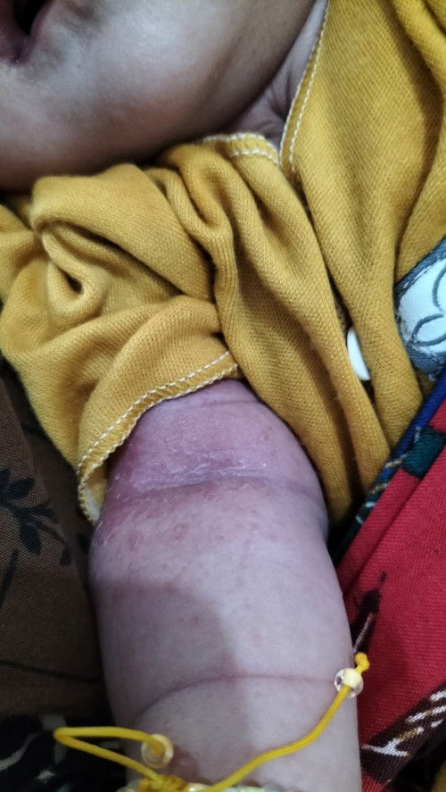 Bun tangan anakku merah2 gini trus kulitnya agak ngelupas,kasih apa yg rekom biar hilang🥲