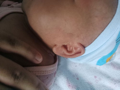 Ruam dekat leher baby