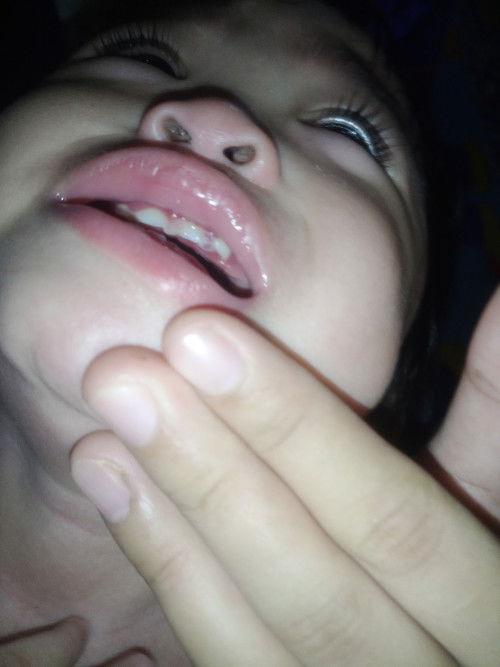 Gusi ada belon air & berbau