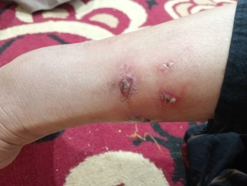 Solusinya dong ibu" timbul koreng di kaki obat yang cocok untuk bumil,baru munculnya di trimester 1