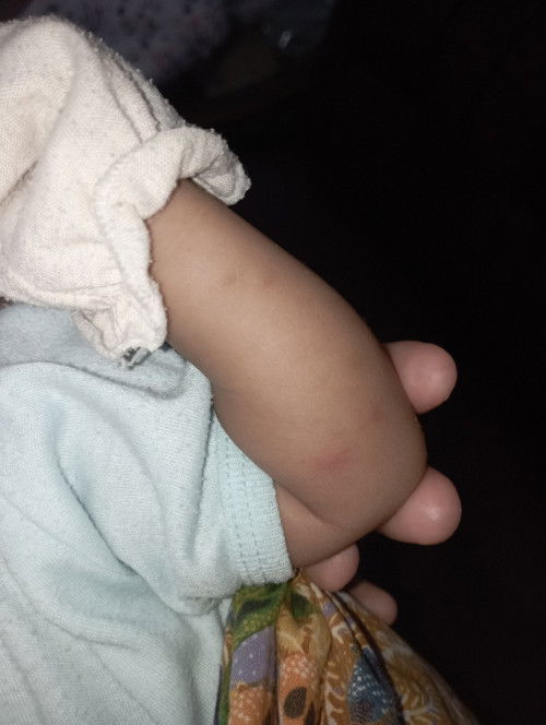 Bekas gigitan nyamuk