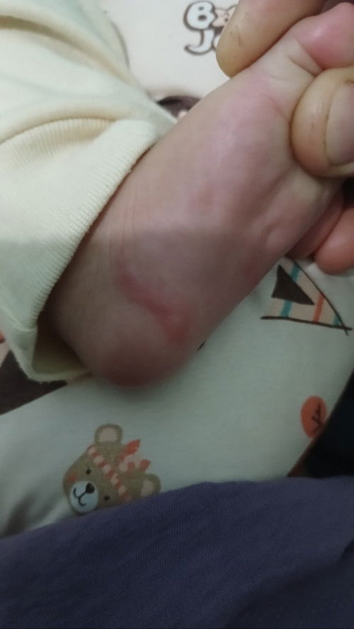 Bengkak memanjang san merah