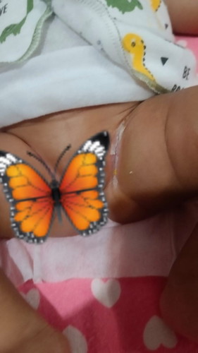 Hallo bun, aku mau nanya ini selangkangan anak ku kaya gini, ini normal ngga iya bun? Terimakasih☺