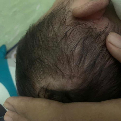 kepala dan telinga bayi kering bersisik