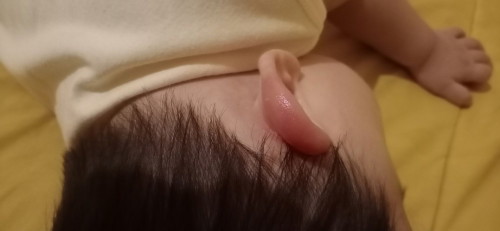 Daun telinga tiba² memerah