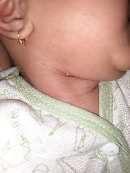 Bayi 2 bulan muncul kulit seperti melepuh