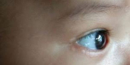 Bentol mdi sekitar kelopak mata