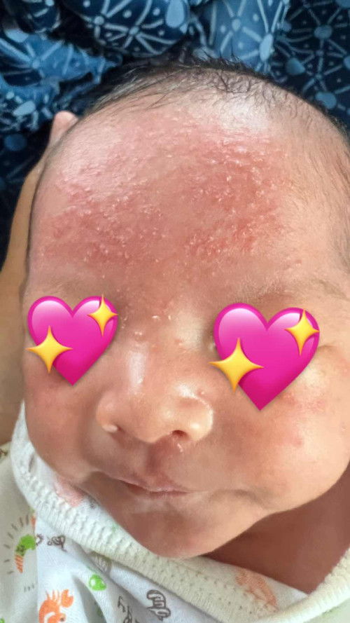 ผดแบบนี้คือผดอะไรคะ สามารถทาครีมตัวไหนได้บ้างไหมคะ