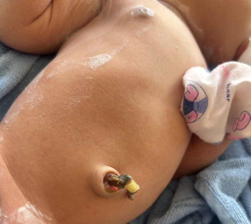 สอบถามแม่ๆ เกี่ยวกับสะดือน้องค่ะ