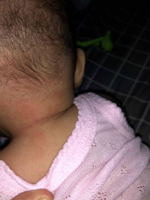 Merah dan gatal dibelakang leher bayi usia 5bln dikasih apa yah mom?