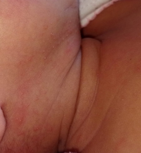 Ruam kt bdn baby umur 10hari