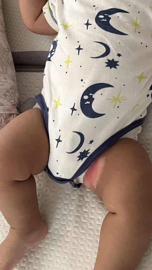 Ruam popok sangat merah