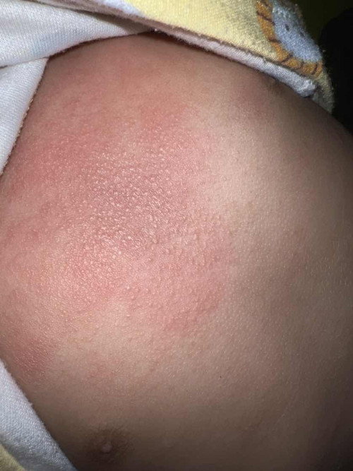 Beruntusan kemerahan