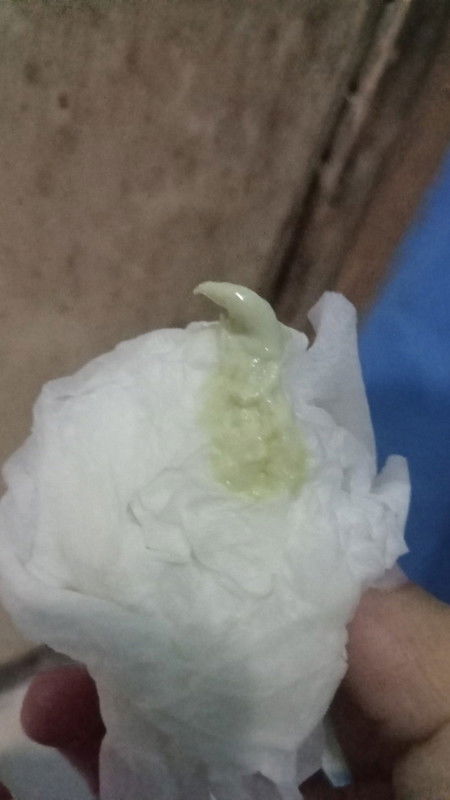 keputihan berlebihan