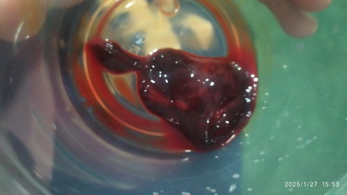 Apa ini Keguguran? keluar gumpalan daging sperti hati ayam