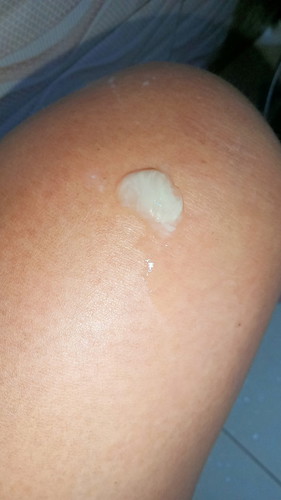 Mucusplug